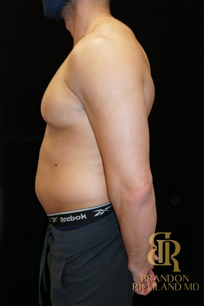 Liposuction Before, Patient 18, view 5 — Dr. Brandon Richland, Newport Beach