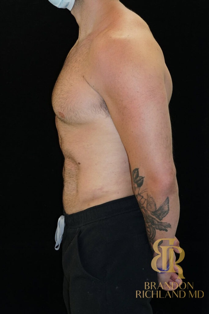 Liposuction After, Patient 18, view 5 — Dr. Brandon Richland, Newport Beach