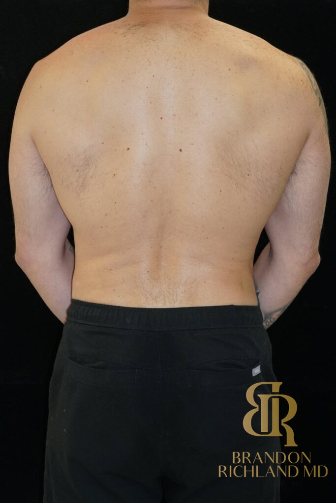 Liposuction After, Patient 18, view 6 — Dr. Brandon Richland, Newport Beach