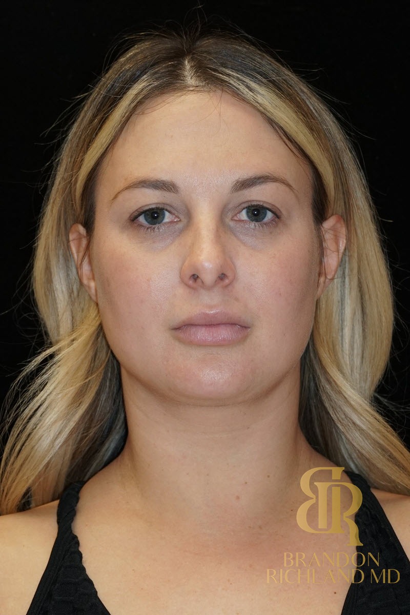 Liposuction before and after, Patient 19 — Dr. Brandon Richland, Newport Beach