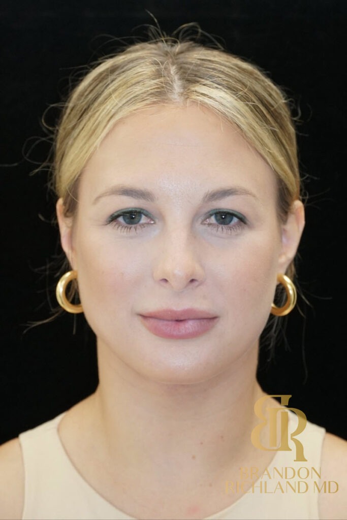 Liposuction After, Patient 19, view 1 — Dr. Brandon Richland, Newport Beach