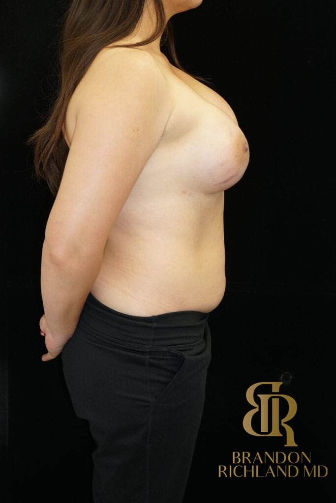 Liposuction Before, Patient 21, view 3 — Dr. Brandon Richland, Newport Beach