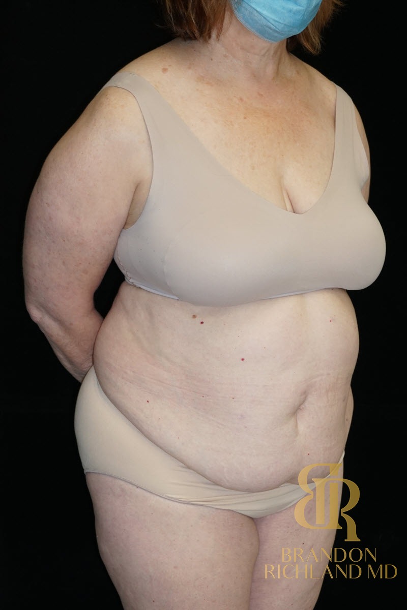 Liposuction before and after, Patient 25 — Dr. Brandon Richland, Newport Beach