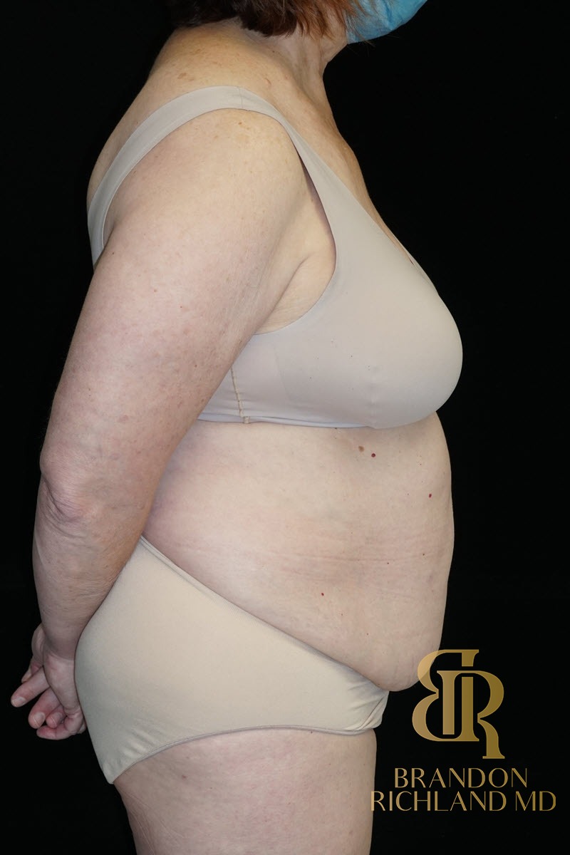 Liposuction before and after, Patient 25 — Dr. Brandon Richland, Newport Beach