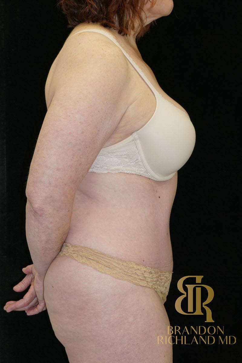 Liposuction before and after, Patient 25 — Dr. Brandon Richland, Newport Beach