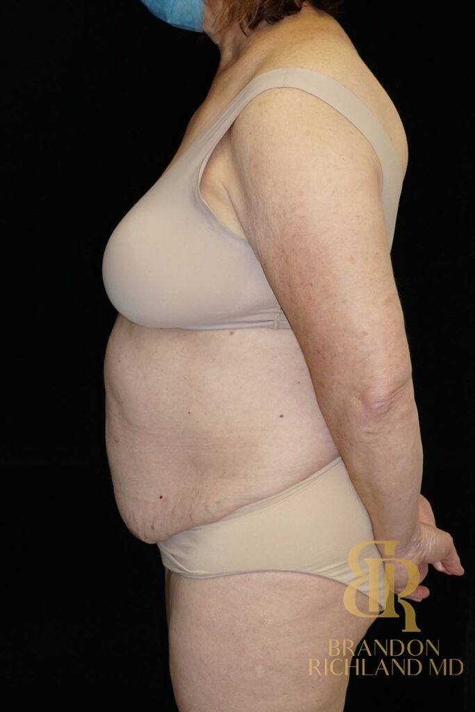 Liposuction Before, Patient 25, view 5 — Dr. Brandon Richland, Newport Beach