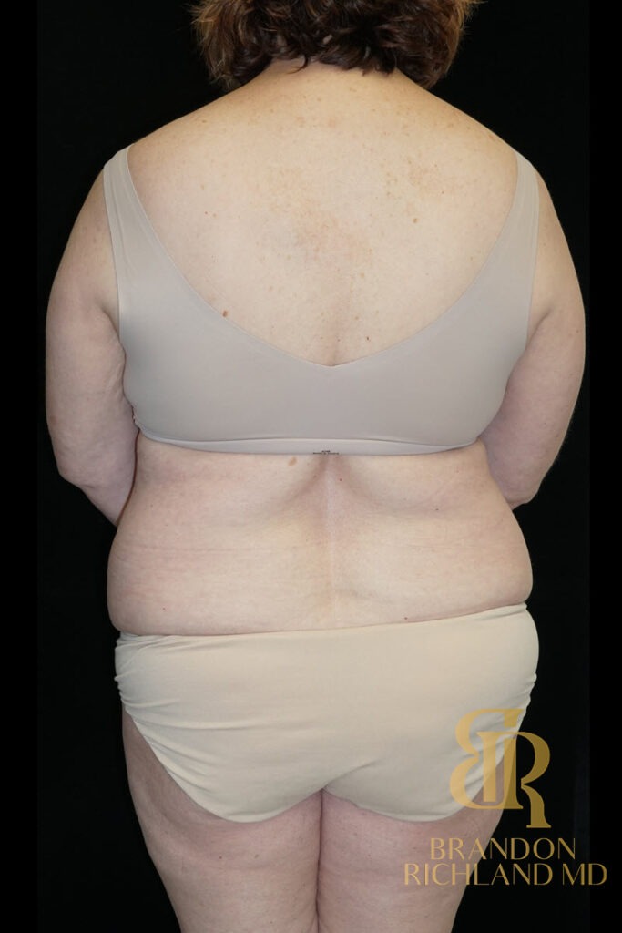 Liposuction Before, Patient 25, view 6 — Dr. Brandon Richland, Newport Beach