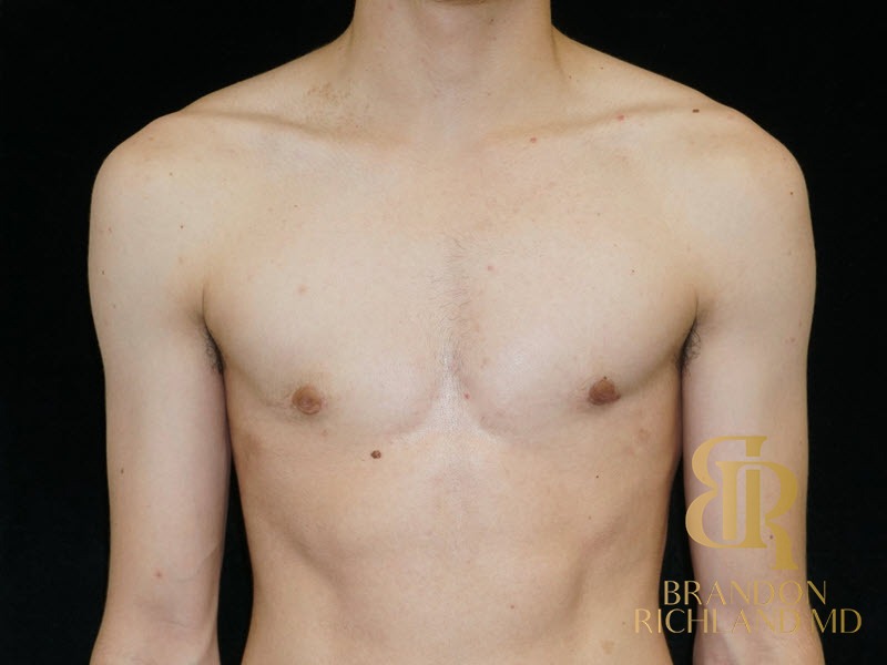 Liposuction before and after, Patient 26 — Dr. Brandon Richland, Newport Beach