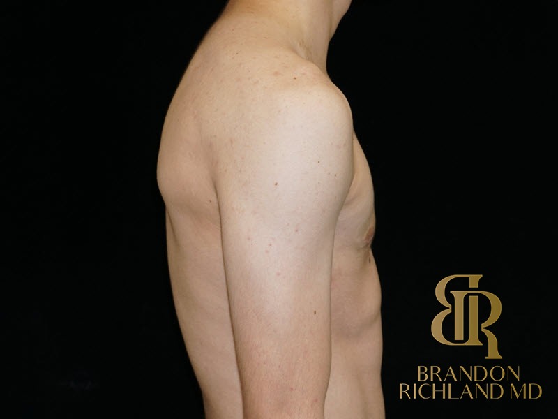 Liposuction before and after, Patient 26 — Dr. Brandon Richland, Newport Beach
