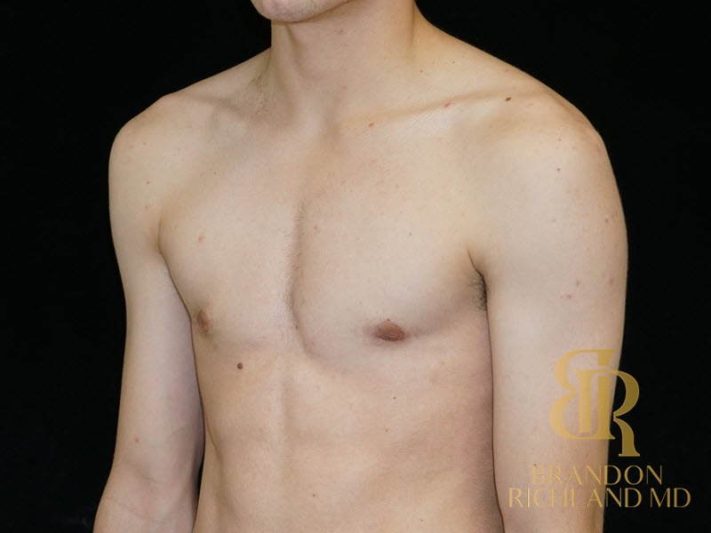 Liposuction After, Patient 26, view 4 — Dr. Brandon Richland, Newport Beach