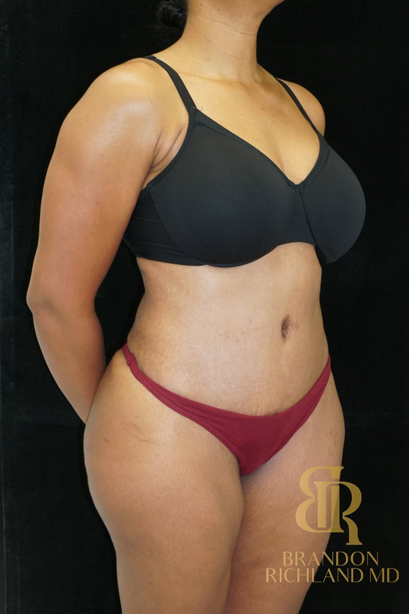 Liposuction before and after, Patient 27 — Dr. Brandon Richland, Newport Beach