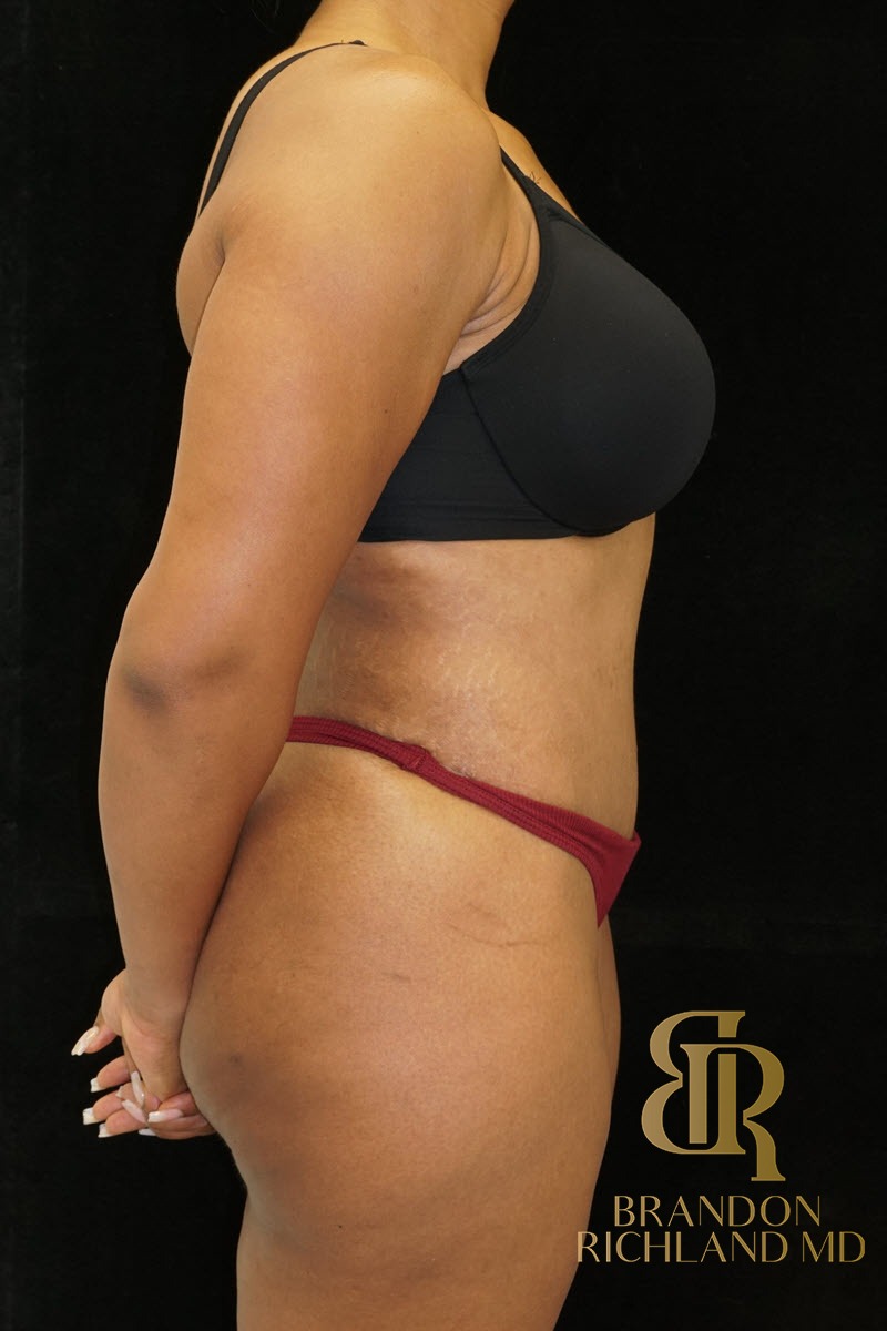 Liposuction before and after, Patient 27 — Dr. Brandon Richland, Newport Beach