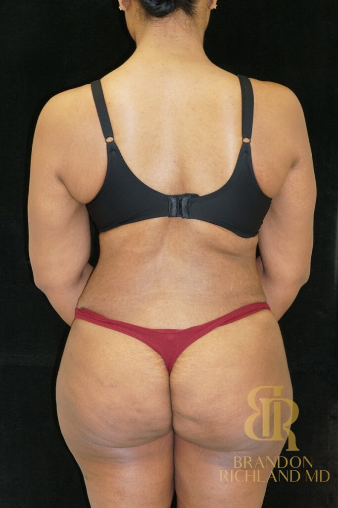 Liposuction After, Patient 27, view 6 — Dr. Brandon Richland, Newport Beach
