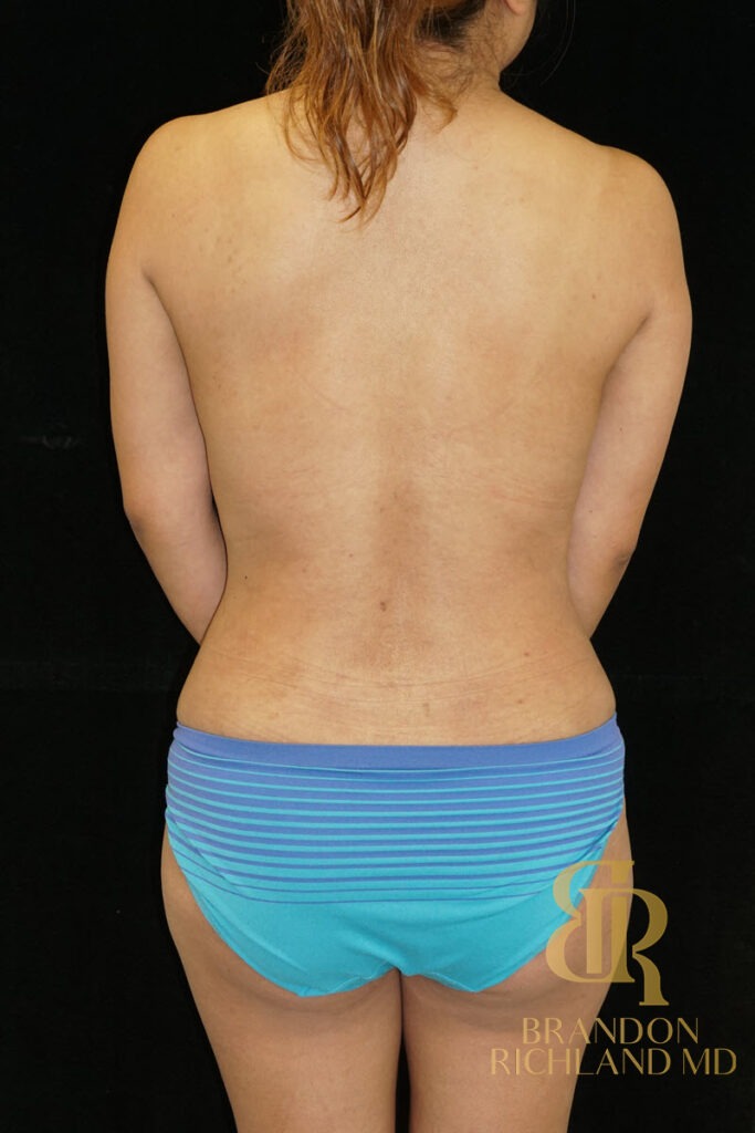 Liposuction After, Patient 28, view 6 — Dr. Brandon Richland, Newport Beach