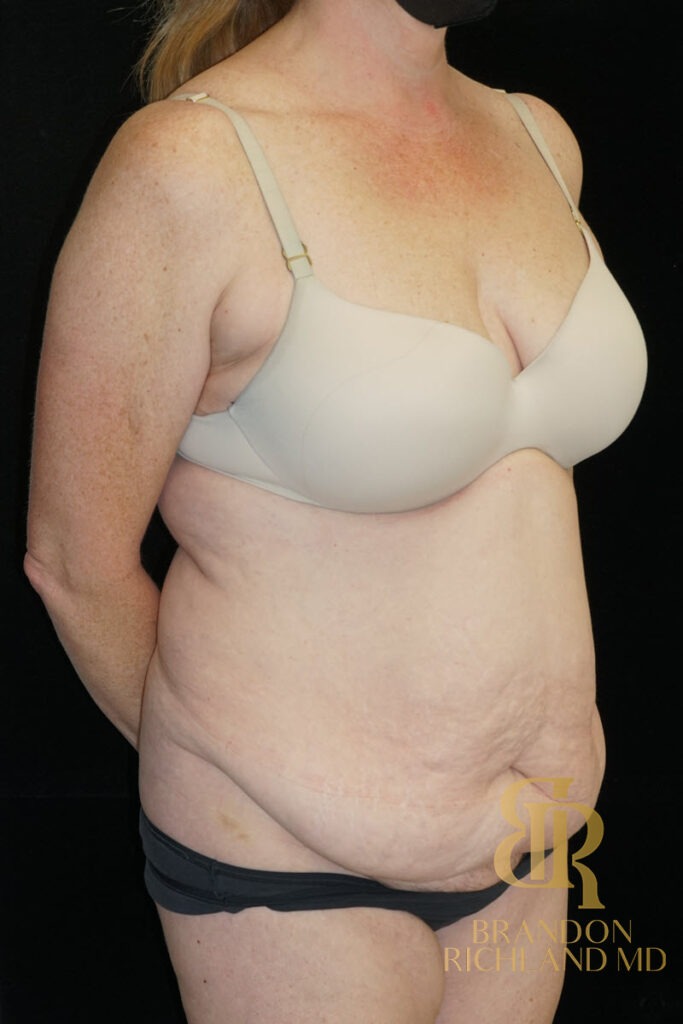 Liposuction Before, Patient 29, view 2 — Dr. Brandon Richland, Newport Beach