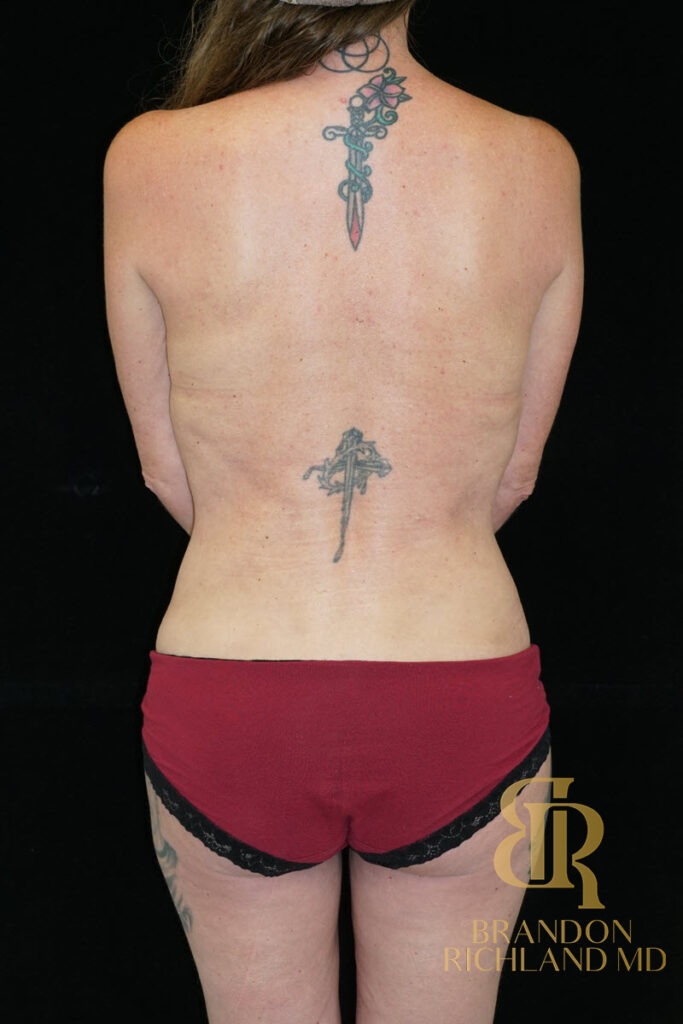 Liposuction After, Patient 32, view 6 — Dr. Brandon Richland, Newport Beach