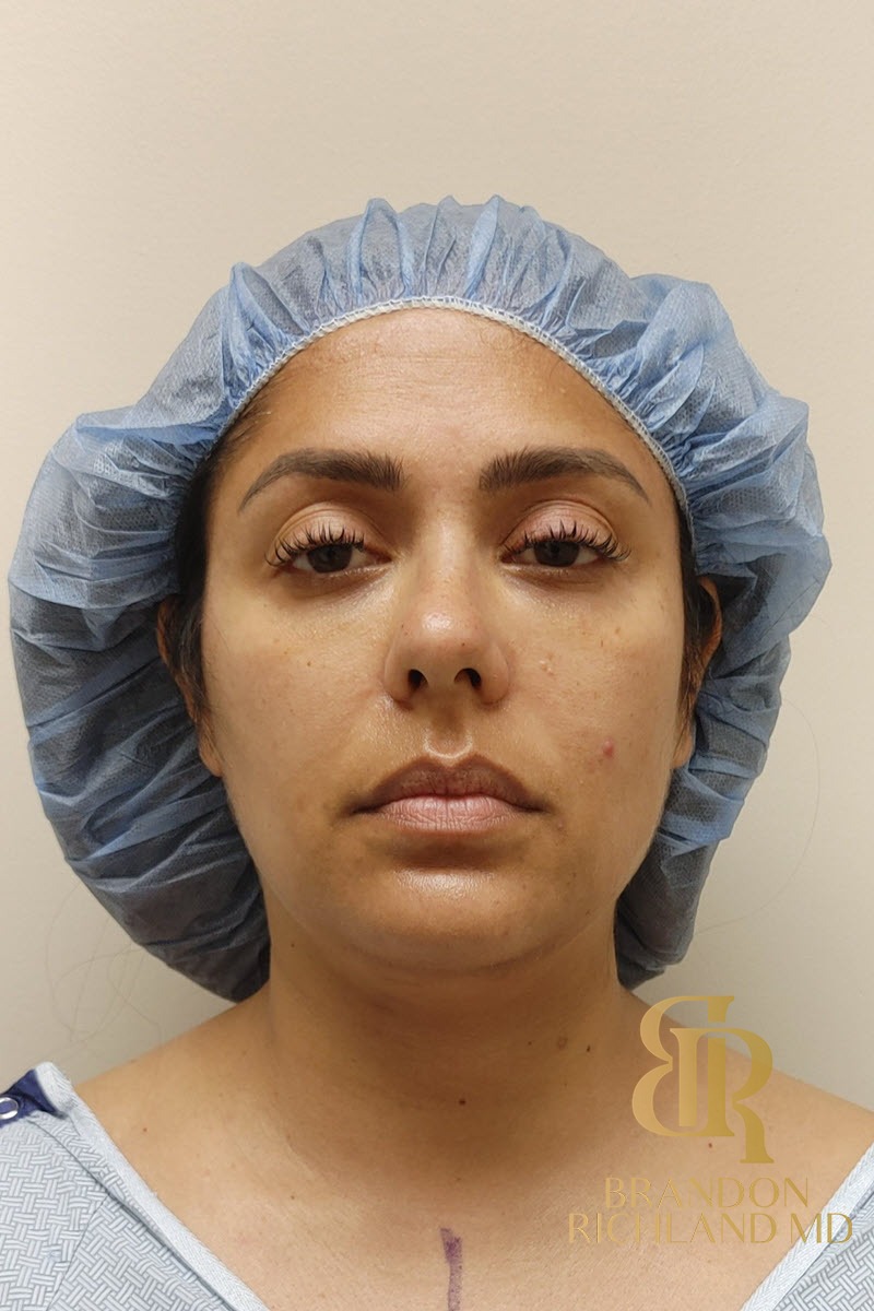 Liposuction before and after, Patient 33 — Dr. Brandon Richland, Newport Beach