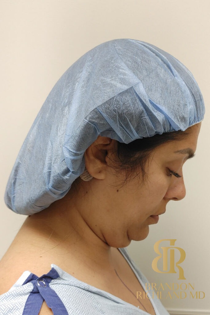 Liposuction Before, Patient 33, view 4 — Dr. Brandon Richland, Newport Beach