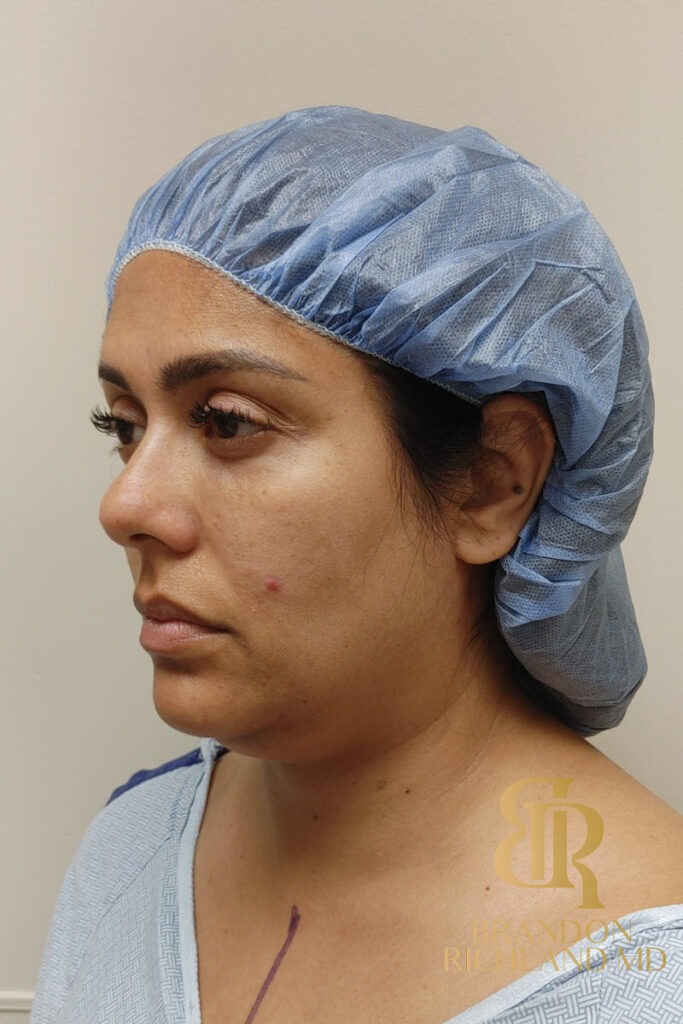 Liposuction Before, Patient 33, view 5 — Dr. Brandon Richland, Newport Beach