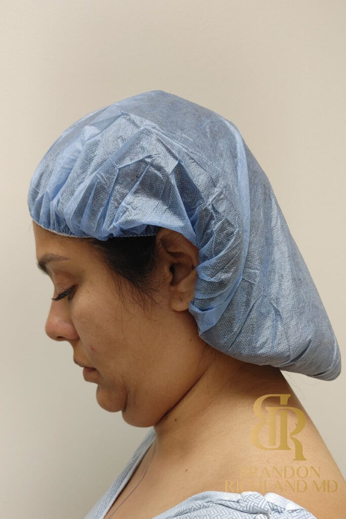 Liposuction Before, Patient 33, view 7 — Dr. Brandon Richland, Newport Beach
