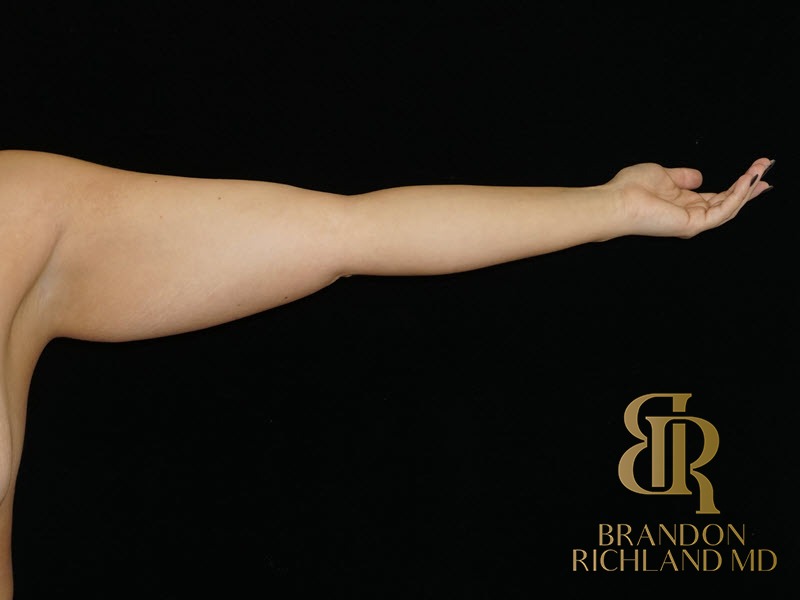 Liposuction Before, Patient 34, view 1 — Dr. Brandon Richland, Newport Beach