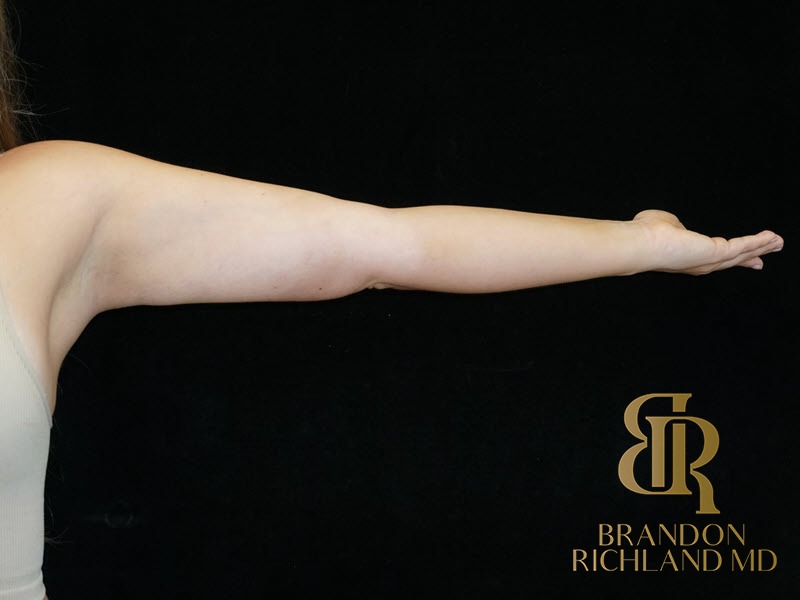 Liposuction After, Patient 34, view 1 — Dr. Brandon Richland, Newport Beach