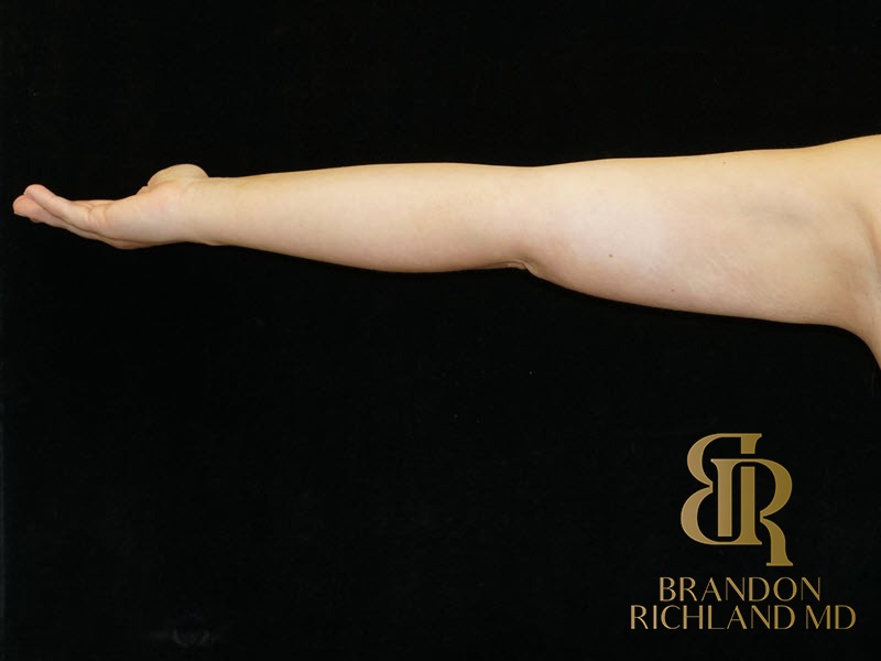Liposuction After, Patient 34, view 2 — Dr. Brandon Richland, Newport Beach