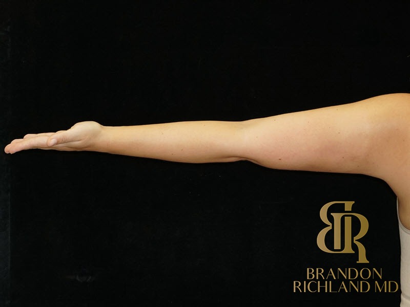Liposuction After, Patient 34, view 4 — Dr. Brandon Richland, Newport Beach