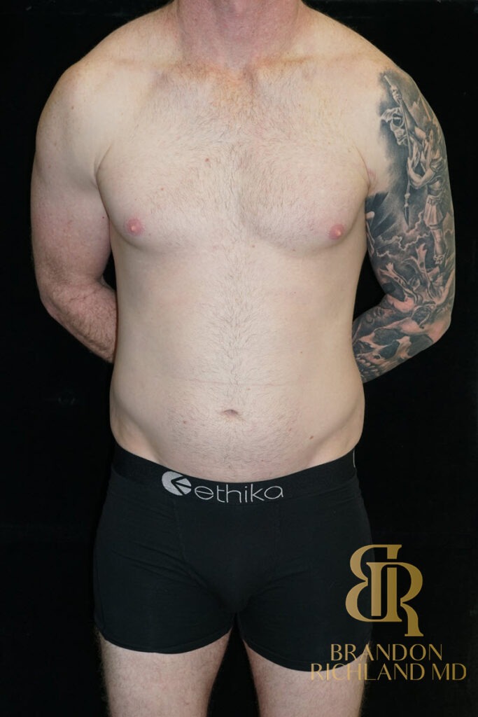 Liposuction Before, Patient 35, view 1 — Dr. Brandon Richland, Newport Beach
