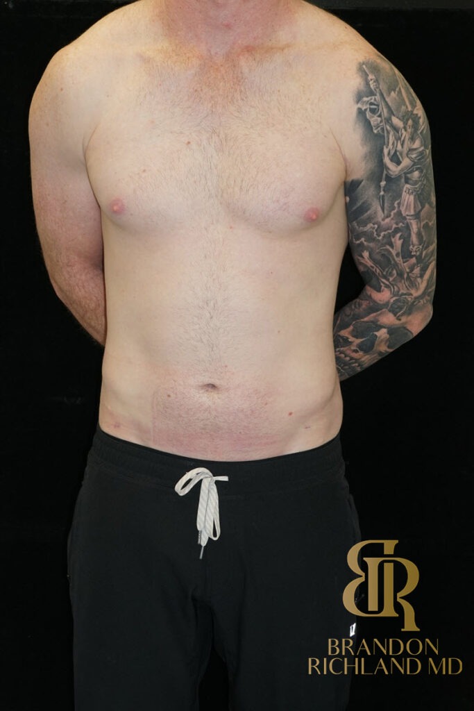 Liposuction After, Patient 35, view 1 — Dr. Brandon Richland, Newport Beach