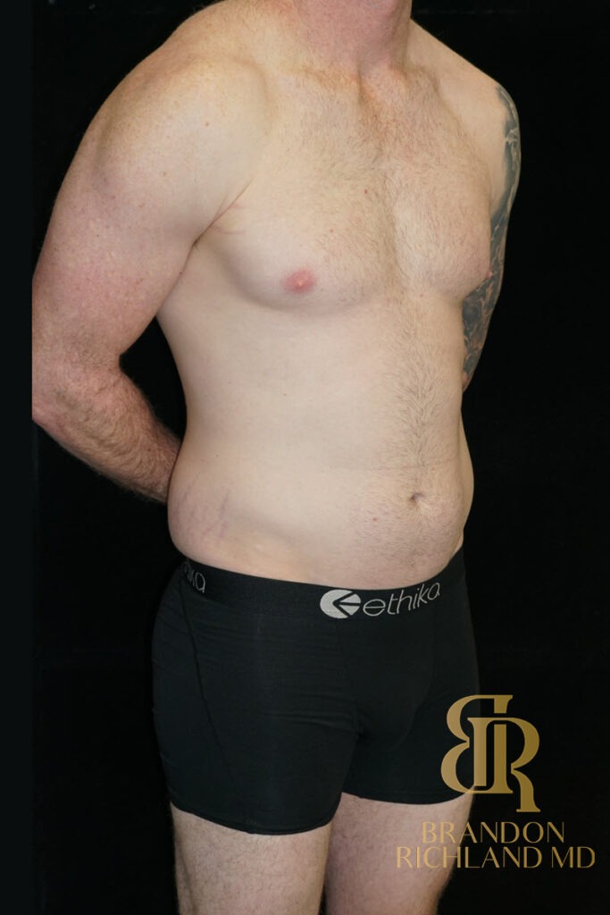 Liposuction Before, Patient 35, view 2 — Dr. Brandon Richland, Newport Beach