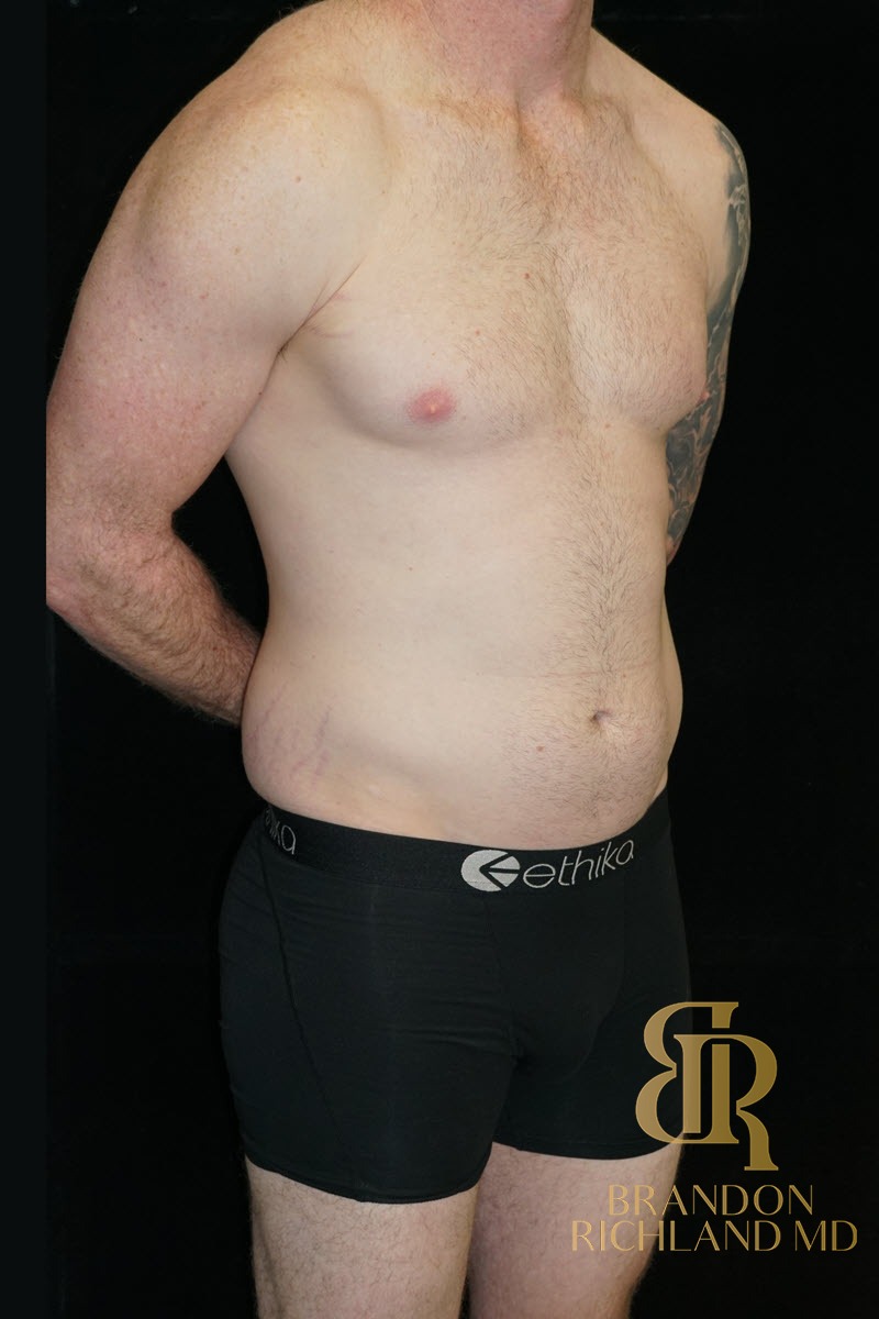Liposuction before and after, Patient 35 — Dr. Brandon Richland, Newport Beach