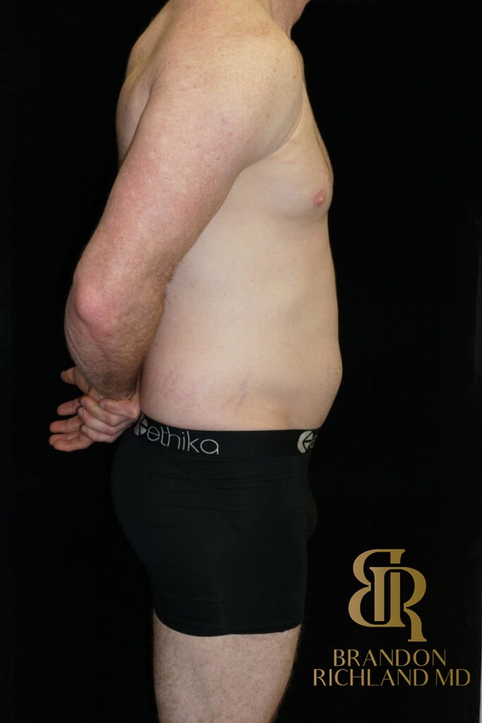 Liposuction Before, Patient 35, view 3 — Dr. Brandon Richland, Newport Beach