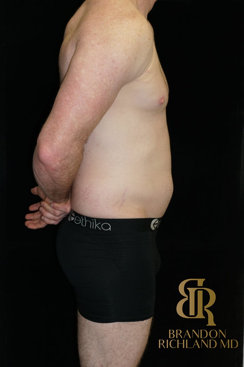 Liposuction before and after, Patient 35 — Dr. Brandon Richland, Newport Beach