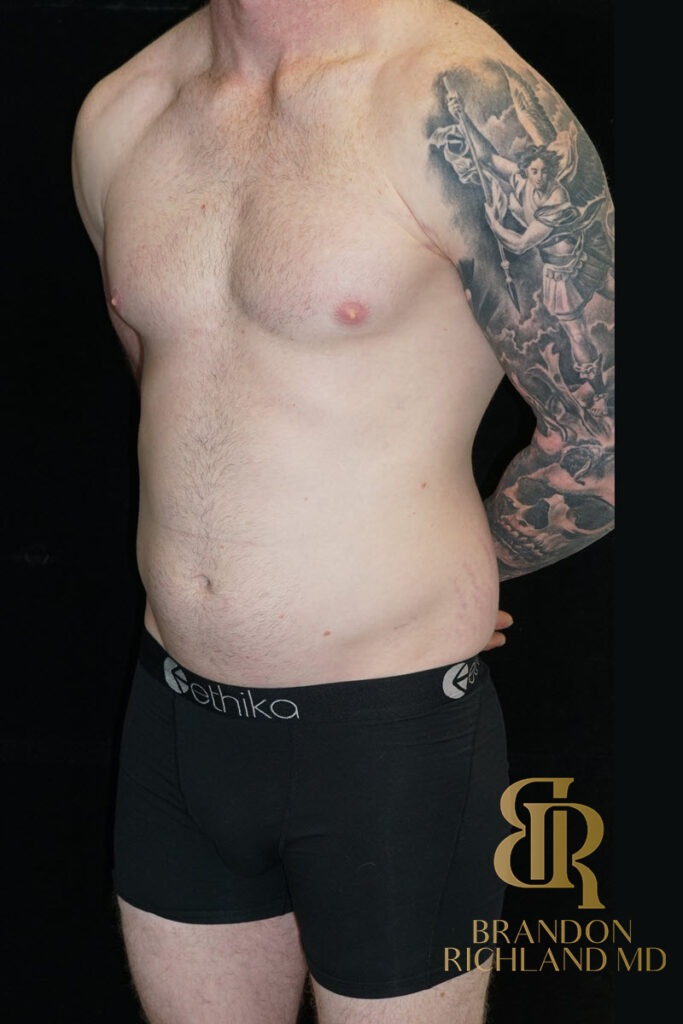 Liposuction Before, Patient 35, view 4 — Dr. Brandon Richland, Newport Beach