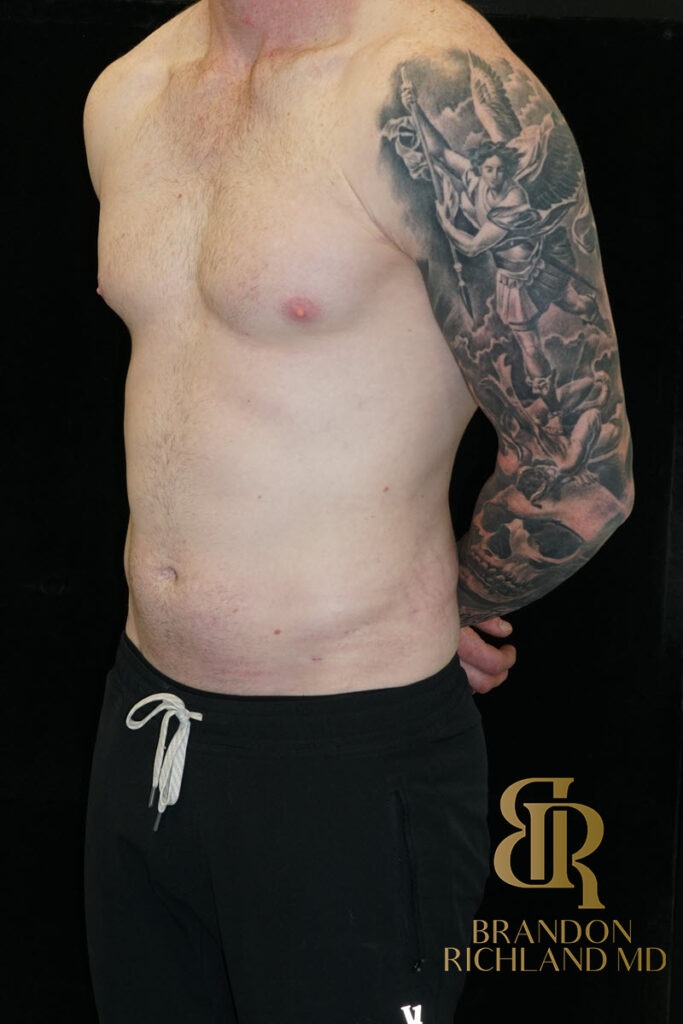 Liposuction After, Patient 35, view 4 — Dr. Brandon Richland, Newport Beach