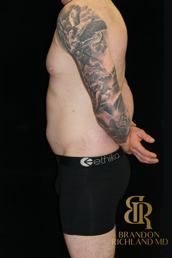 Liposuction Before, Patient 35, view 5 — Dr. Brandon Richland, Newport Beach