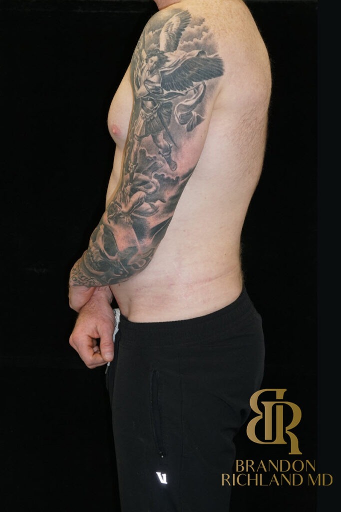 Liposuction After, Patient 35, view 5 — Dr. Brandon Richland, Newport Beach