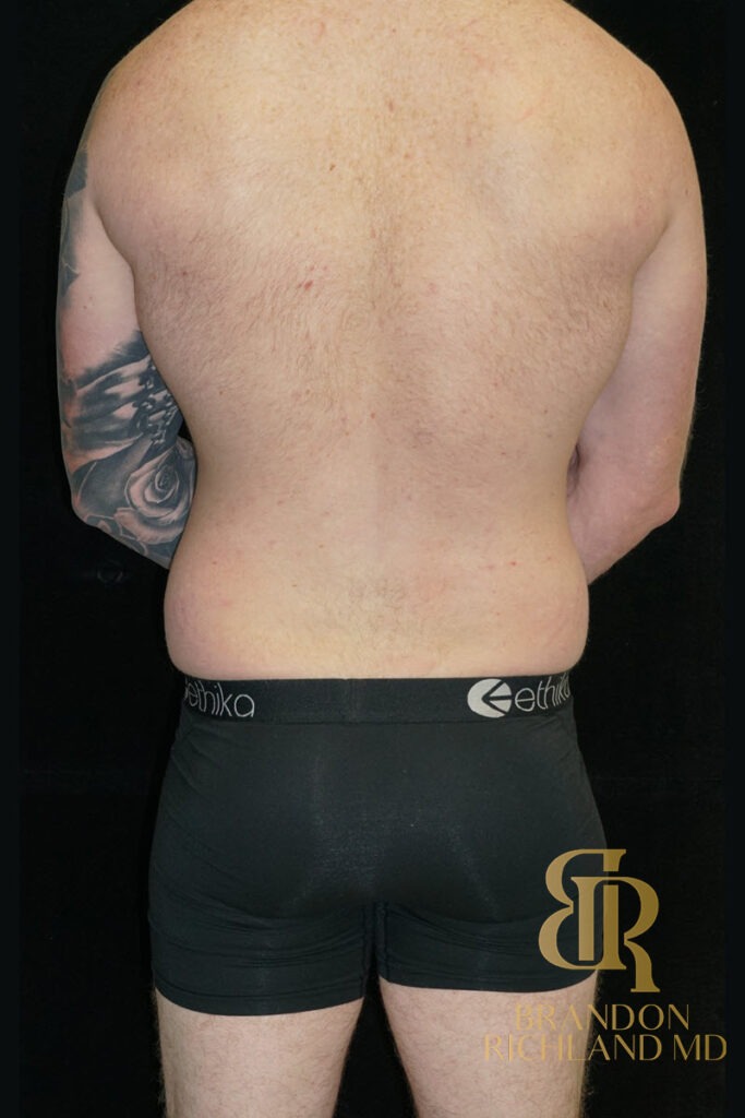 Liposuction Before, Patient 35, view 6 — Dr. Brandon Richland, Newport Beach