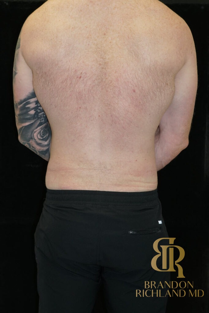Liposuction After, Patient 35, view 6 — Dr. Brandon Richland, Newport Beach