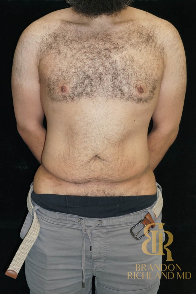 Liposuction Before, Patient 36, view 1 — Dr. Brandon Richland, Newport Beach