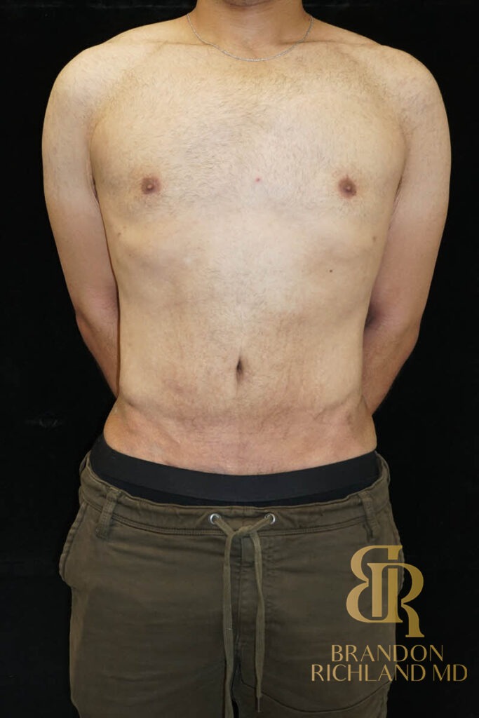 Liposuction After, Patient 36, view 1 — Dr. Brandon Richland, Newport Beach