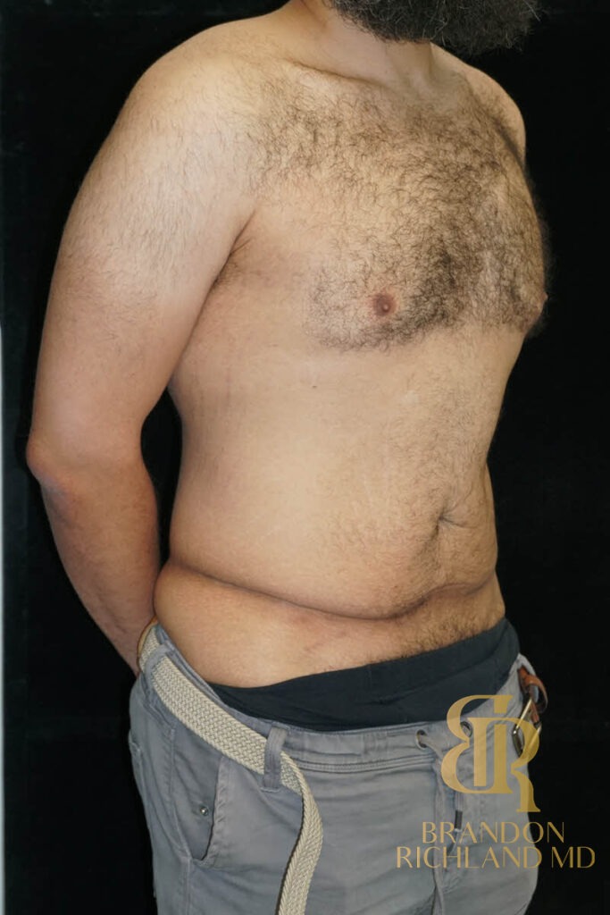 Liposuction Before, Patient 36, view 2 — Dr. Brandon Richland, Newport Beach