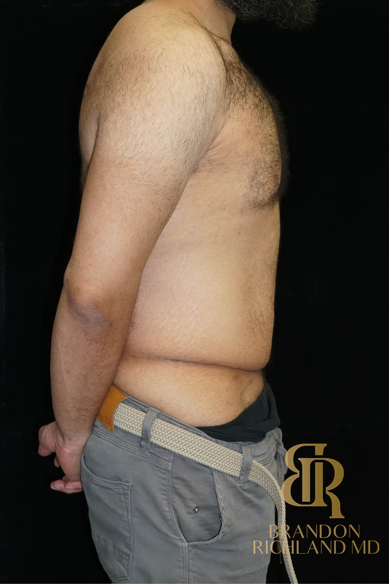 Liposuction before and after, Patient 36 — Dr. Brandon Richland, Newport Beach