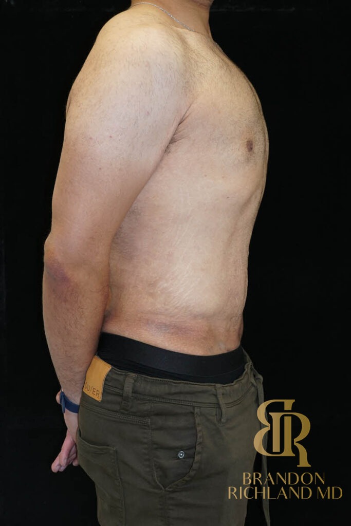 Liposuction After, Patient 36, view 3 — Dr. Brandon Richland, Newport Beach