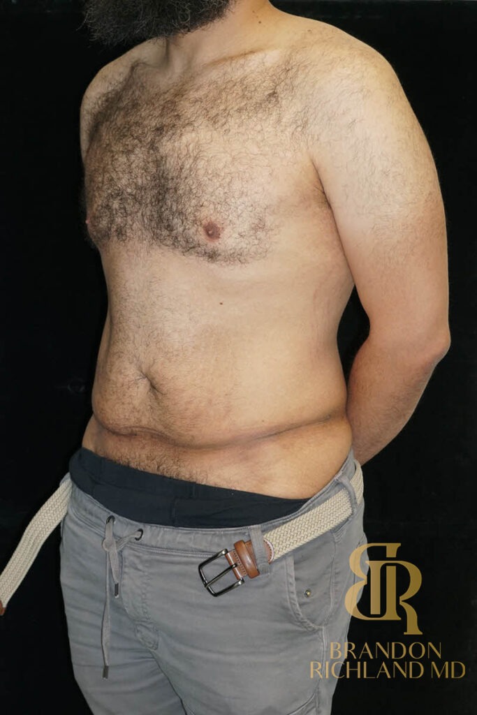 Liposuction Before, Patient 36, view 4 — Dr. Brandon Richland, Newport Beach