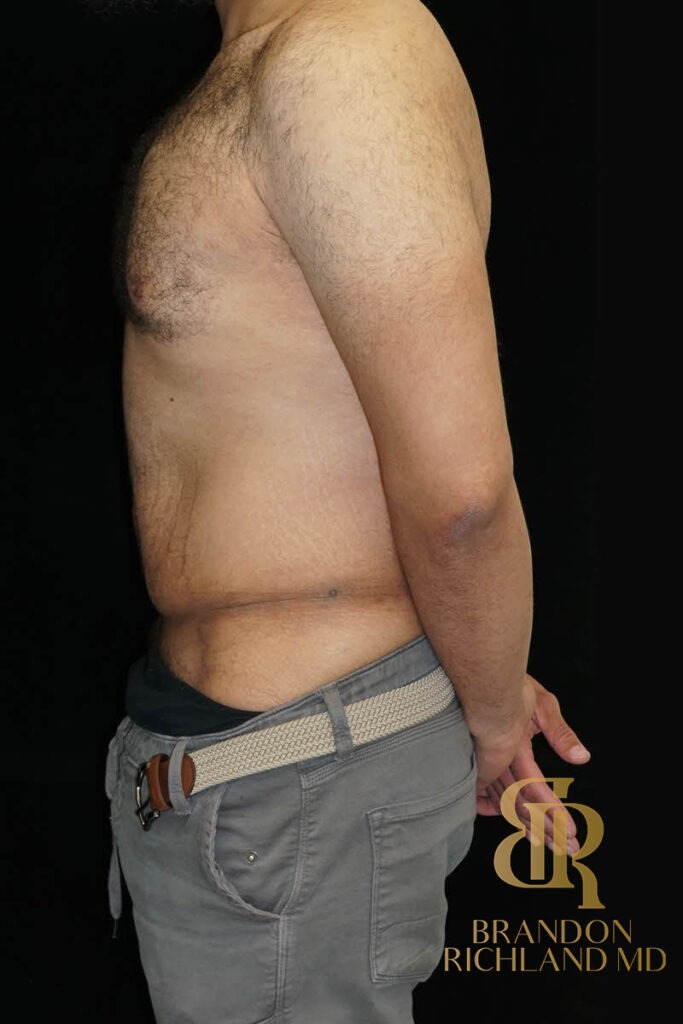 Liposuction Before, Patient 36, view 5 — Dr. Brandon Richland, Newport Beach