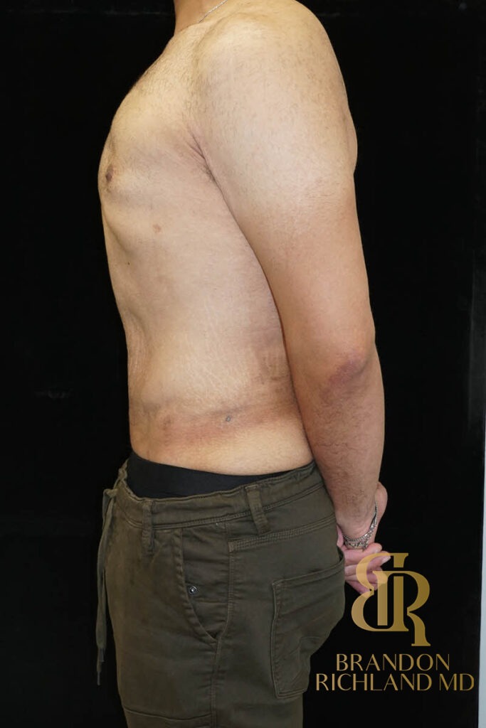 Liposuction After, Patient 36, view 5 — Dr. Brandon Richland, Newport Beach