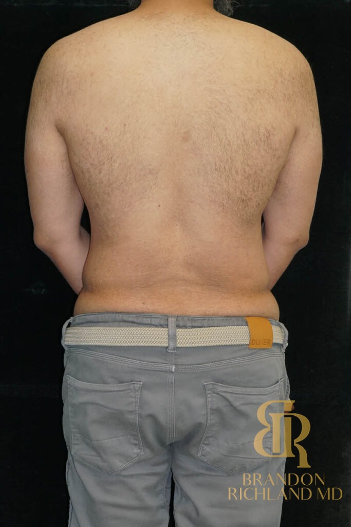 Liposuction Before, Patient 36, view 6 — Dr. Brandon Richland, Newport Beach