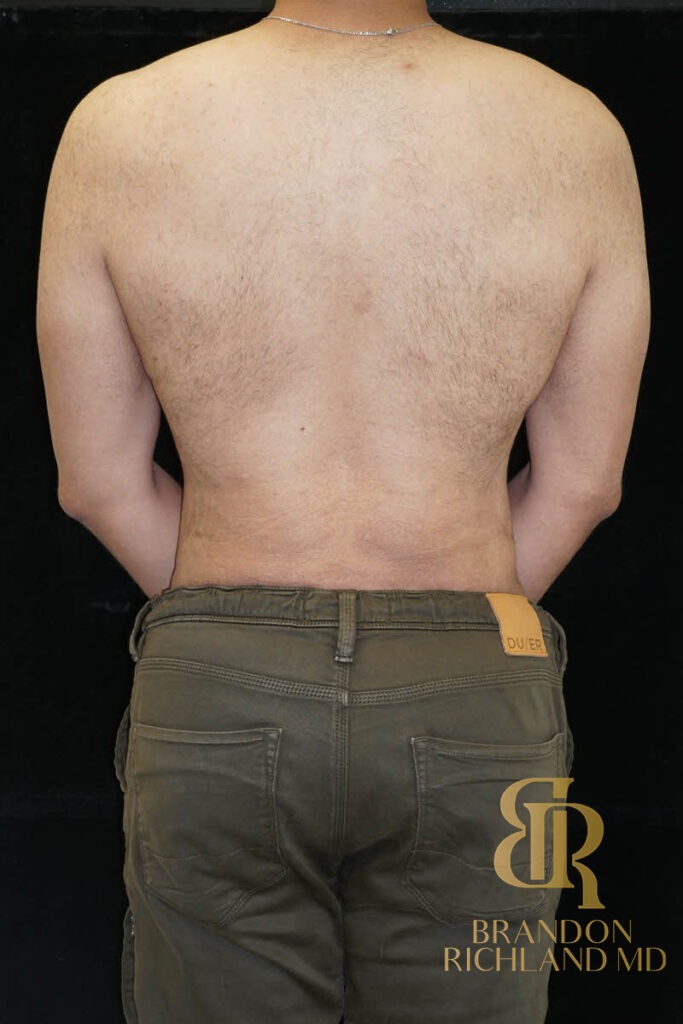 Liposuction After, Patient 36, view 6 — Dr. Brandon Richland, Newport Beach